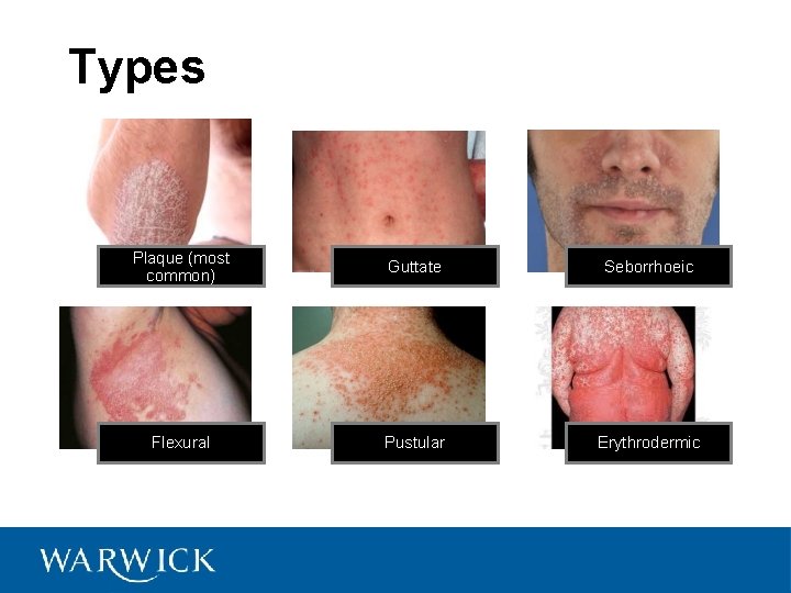 Types Plaque (most common) Guttate Seborrhoeic Flexural Pustular Erythrodermic 