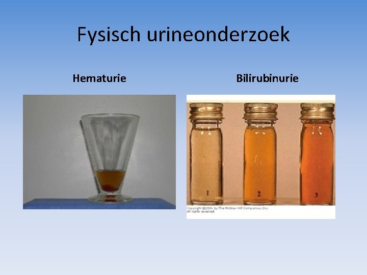 Fysisch urineonderzoek Hematurie Bilirubinurie 