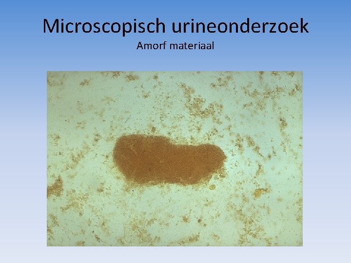 Microscopisch urineonderzoek Amorf materiaal 