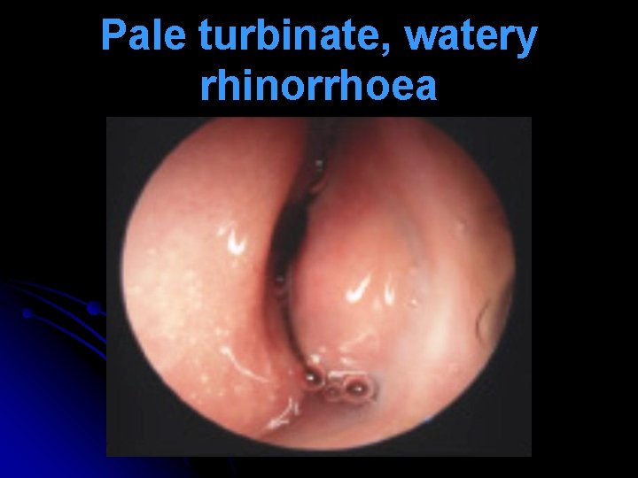 Pale turbinate, watery rhinorrhoea 