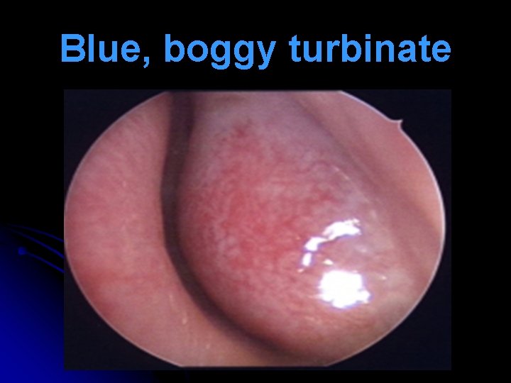 Blue, boggy turbinate 