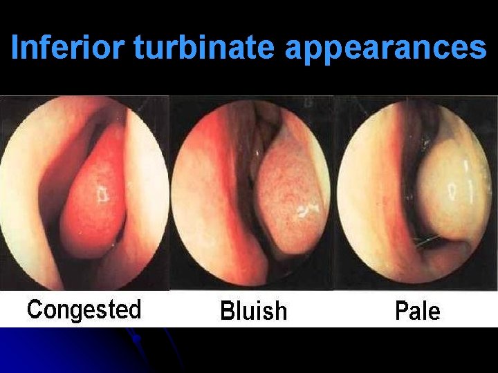 Inferior turbinate appearances 