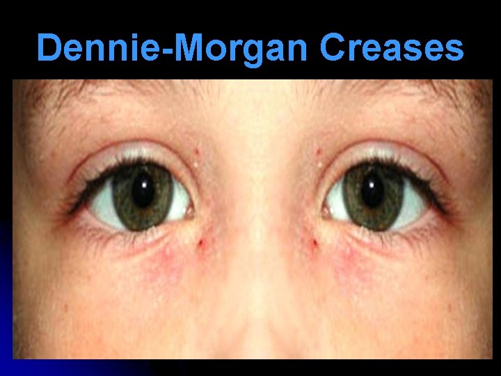 Dennie-Morgan Creases 