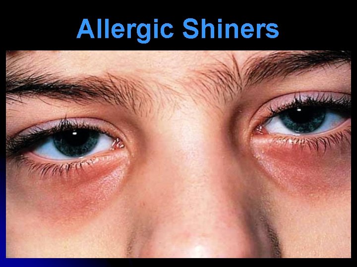 Allergic Shiners 