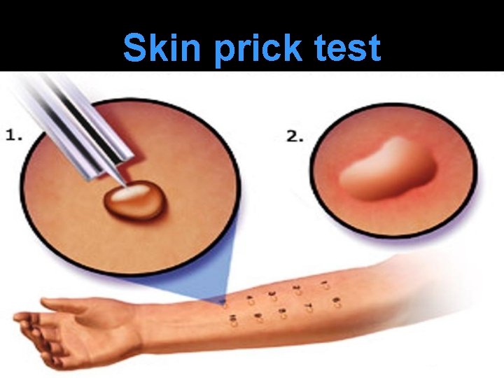 Skin prick test 