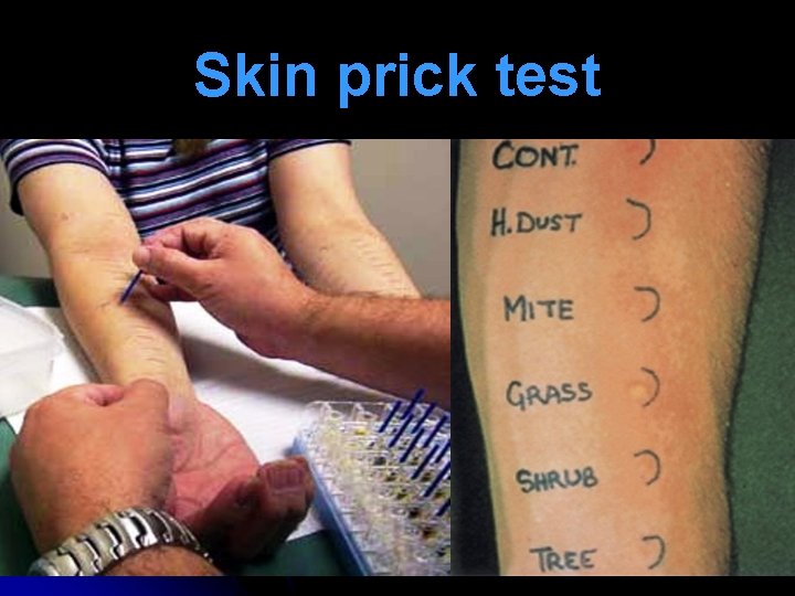 Skin prick test 