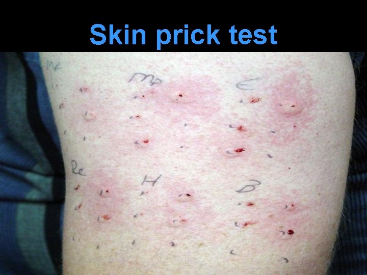 Skin prick test 