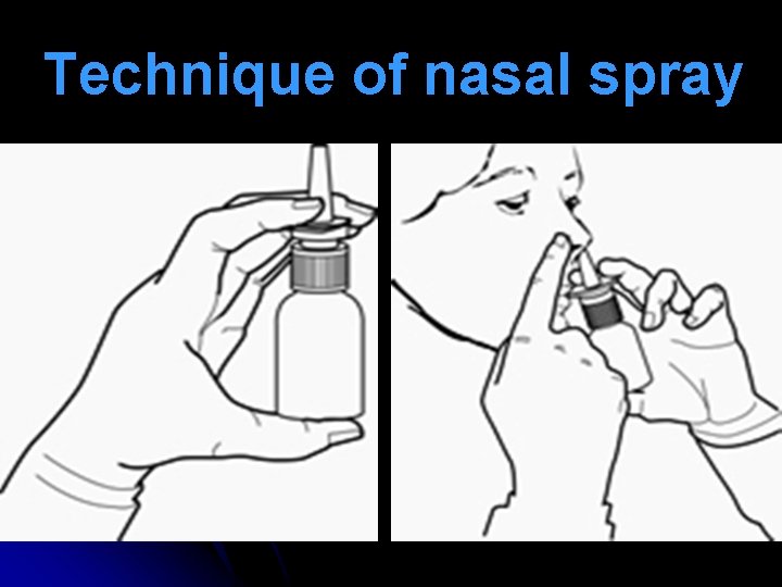 Technique of nasal spray 