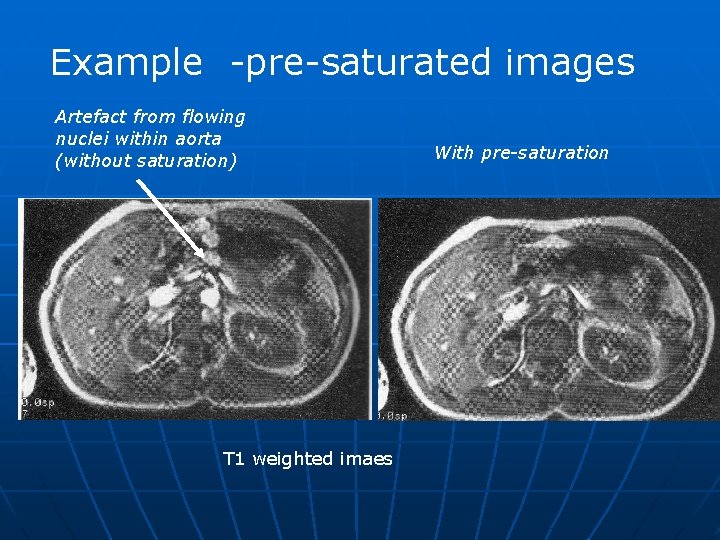 Example -pre-saturated images Artefact from flowing nuclei within aorta (without saturation) T 1 weighted