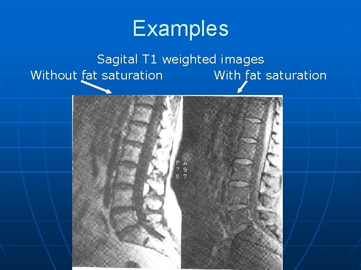 Examples Sagital T 1 weighted images Without fat saturation With fat saturation 