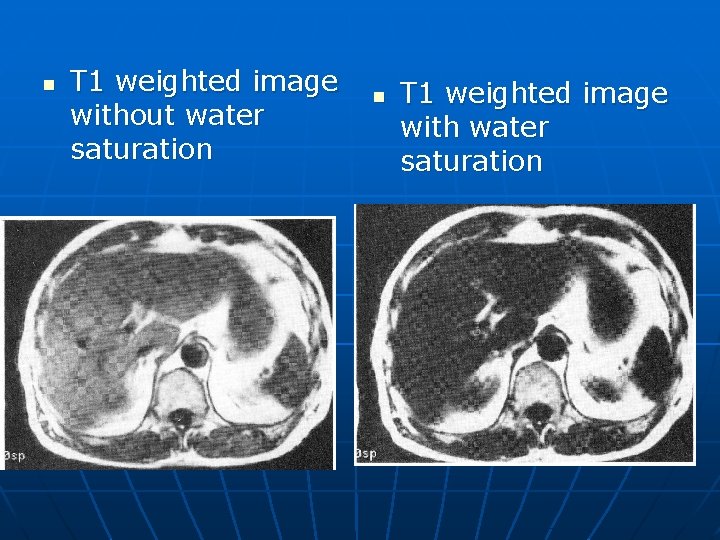 n T 1 weighted image without water saturation n T 1 weighted image with