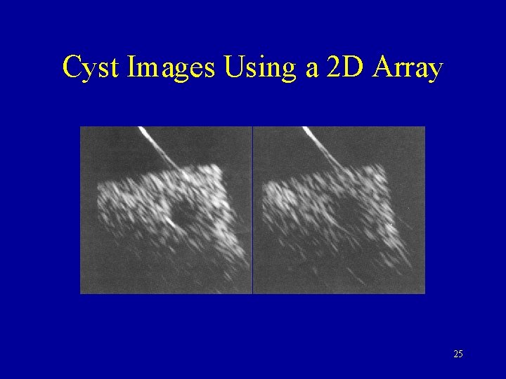 Cyst Images Using a 2 D Array 25 