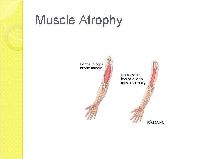 Muscle Atrophy 