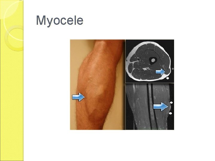 Myocele 