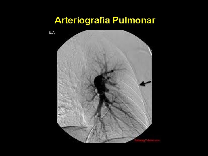 Arteriografia Pulmonar Arteriografia Pulmonar