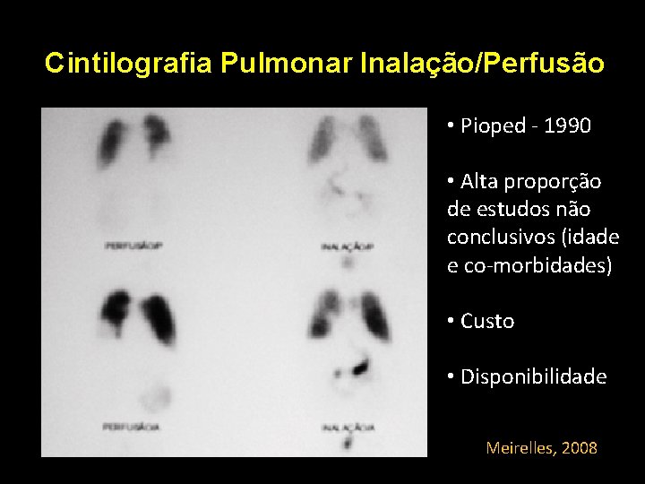 Cintilografia Pulmonar Inalação/Perfusão • Pioped - 1990 • Alta proporção de estudos não conclusivos Cintilografia Pulmonar Inalação/Perfusão • Pioped - 1990 • Alta proporção de estudos não conclusivos