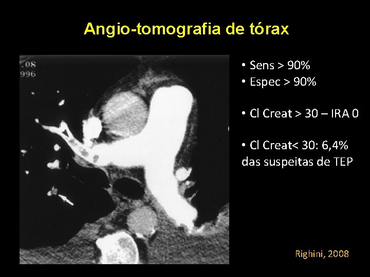 Angio-tomografia de tórax • Sens > 90% • Espec > 90% • Cl Creat Angio-tomografia de tórax • Sens > 90% • Espec > 90% • Cl Creat