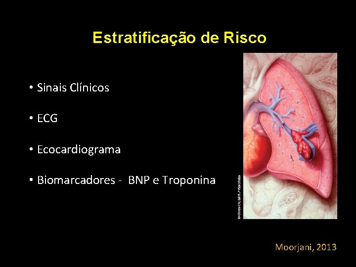 Estratificação de Risco • Sinais Clínicos • ECG • Ecocardiograma • Biomarcadores - BNP Estratificação de Risco • Sinais Clínicos • ECG • Ecocardiograma • Biomarcadores - BNP