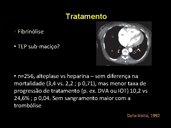 Tratamento • Fibrinólise • TEP sub-maciço? • n=256, alteplase vs heparina – sem diferença Tratamento • Fibrinólise • TEP sub-maciço? • n=256, alteplase vs heparina – sem diferença