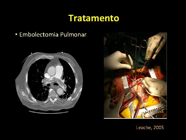 Tratamento • Embolectomia Pulmonar Leache, 2005 Tratamento • Embolectomia Pulmonar Leache, 2005