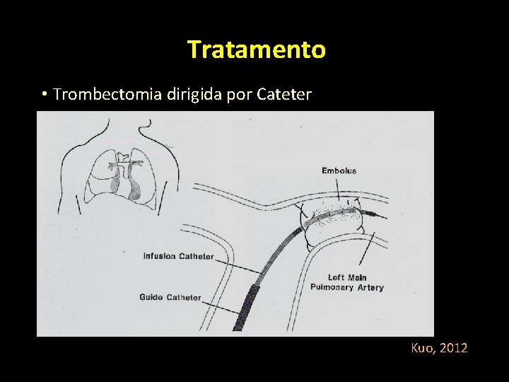 Tratamento • Trombectomia dirigida por Cateter Kuo, 2012 Tratamento • Trombectomia dirigida por Cateter Kuo, 2012