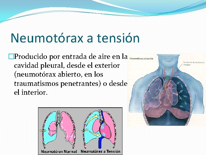 Neumotórax a tensión �Producido por entrada de aire en la cavidad pleural, desde el