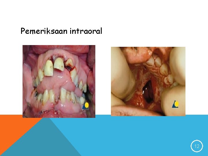 Pemeriksaan intraoral 12 