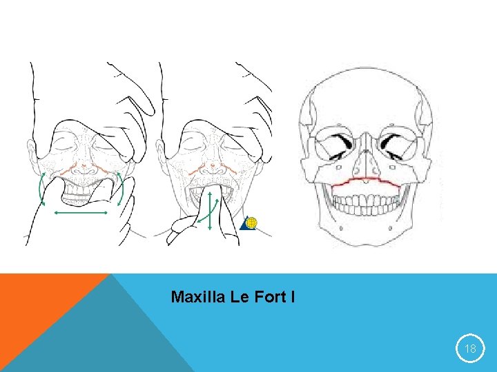 Maxilla Le Fort I 18 