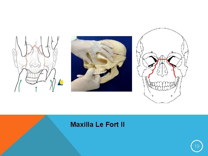 Maxilla Le Fort II 19 