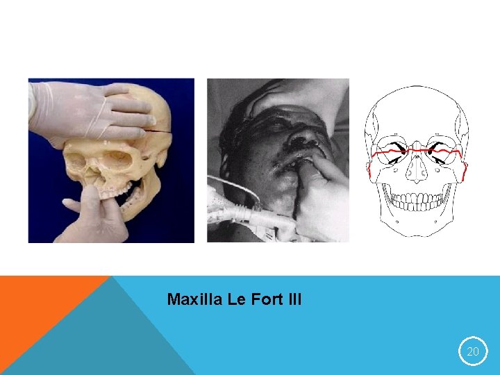 Maxilla Le Fort III 20 