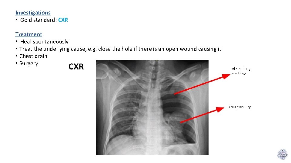 Investigations • Gold standard: CXR Treatment • Heal spontaneously • Treat the underlying cause,