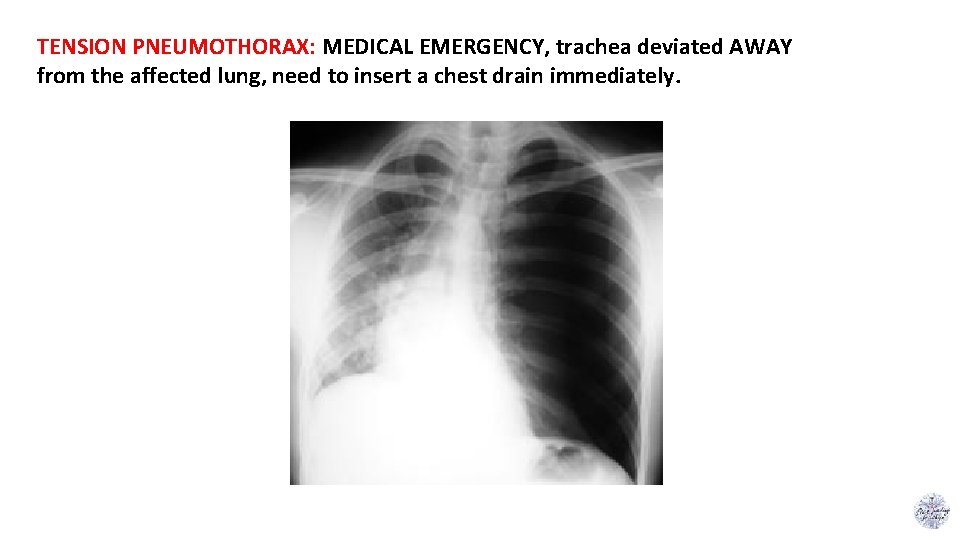 TENSION PNEUMOTHORAX: MEDICAL EMERGENCY, trachea deviated AWAY from the affected lung, need to insert
