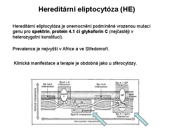 Hereditární eliptocytóza (HE) Hereditární eliptocytóza je onemocnění podmíněné vrozenou mutací genu pro spektrin, protein