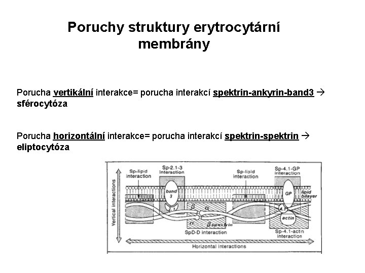 Poruchy struktury erytrocytární membrány Porucha vertikální interakce= porucha interakcí spektrin-ankyrin-band 3 sférocytóza Porucha horizontální