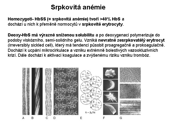 Srpkovitá anémie Homozygoti- Hb. SS (= srpkovitá anémie) tvoří >40% Hb. S a dochází Srpkovitá anémie Homozygoti- Hb. SS (= srpkovitá anémie) tvoří >40% Hb. S a dochází