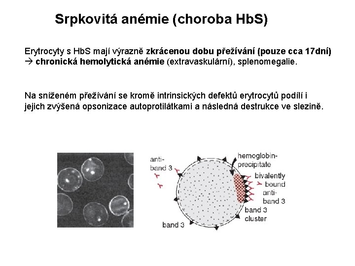 Srpkovitá anémie (choroba Hb. S) Erytrocyty s Hb. S mají výrazně zkrácenou dobu přežívání