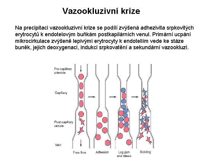 Vazookluzivní krize Na precipitaci vazookluzivní krize se podílí zvýšená adhezivita srpkovitých erytrocytů k endotelovým