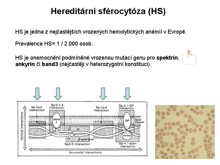 Hereditární sférocytóza (HS) HS je jedna z nejčastějších vrozených hemolytických anémií v Evropě. Prevalence Hereditární sférocytóza (HS) HS je jedna z nejčastějších vrozených hemolytických anémií v Evropě. Prevalence