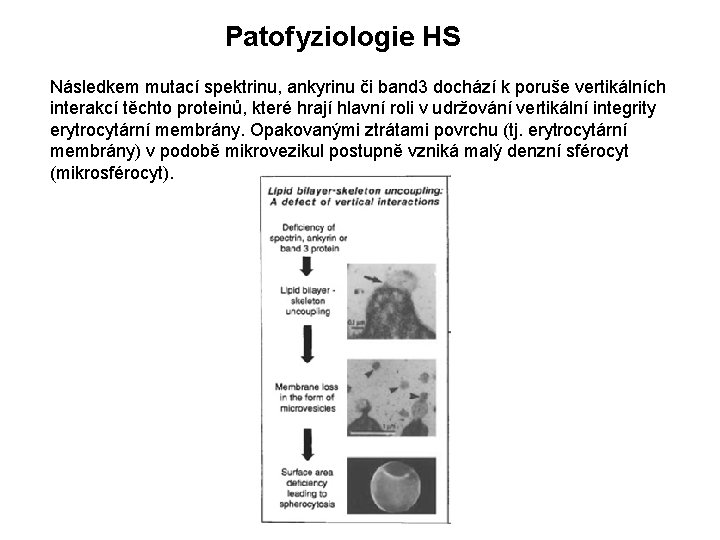 Patofyziologie HS Následkem mutací spektrinu, ankyrinu či band 3 dochází k poruše vertikálních interakcí
