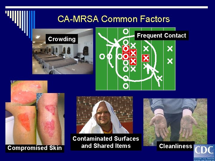CA-MRSA Common Factors Crowding Compromised Skin Frequent Contact Contaminated Surfaces and Shared Items Cleanliness