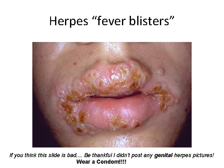 Herpes “fever blisters” If you think this slide is bad. . Be thankful I