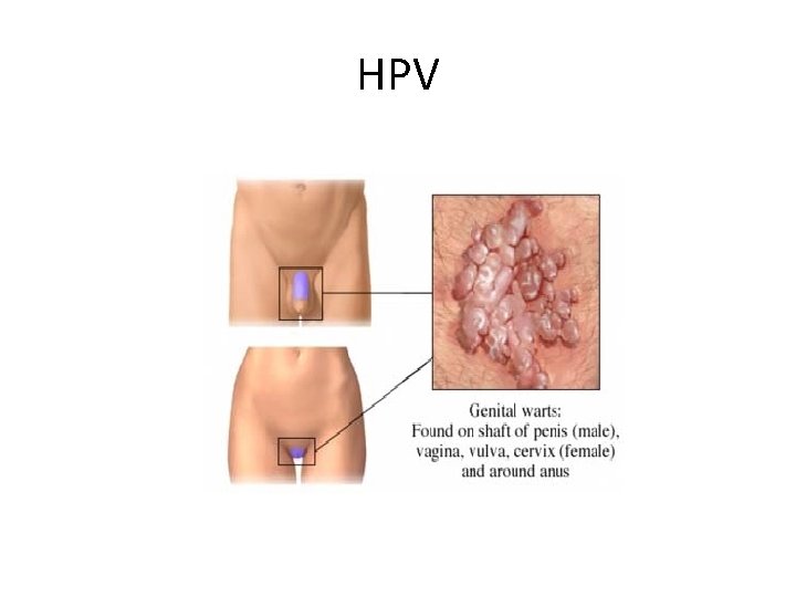 HPV 