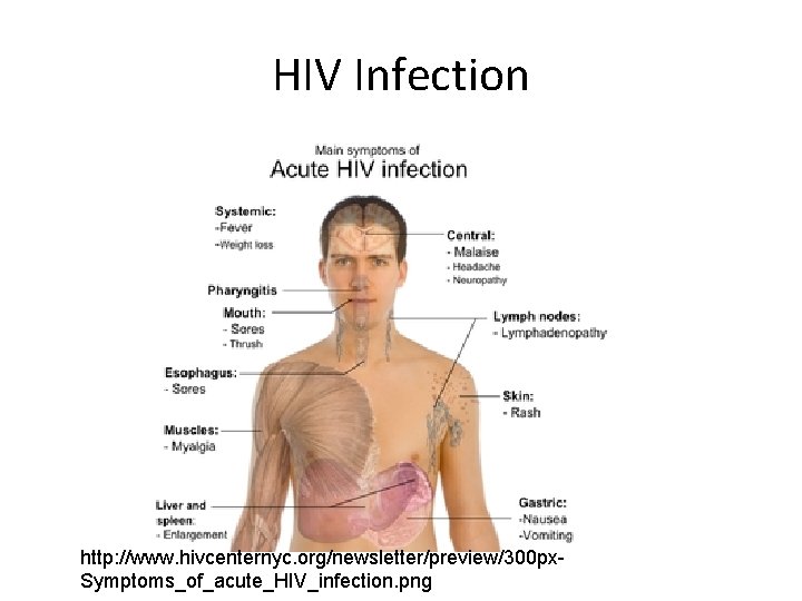 HIV Infection http: //www. hivcenternyc. org/newsletter/preview/300 px. Symptoms_of_acute_HIV_infection. png 