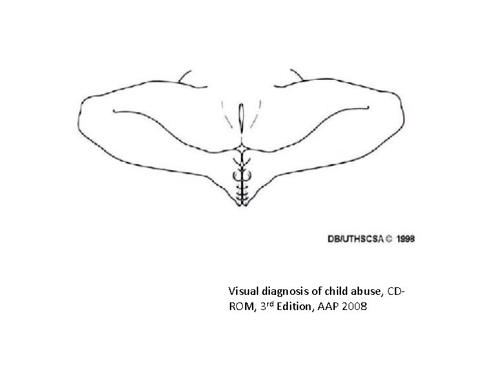 Visual diagnosis of child abuse, CDROM, 3 rd Edition, AAP 2008 