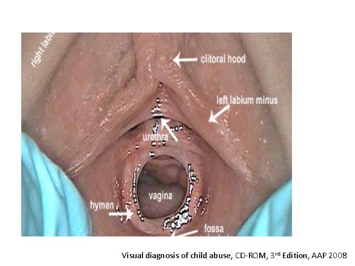 Visual diagnosis of child abuse, CD-ROM, 3 rd Edition, AAP 2008 