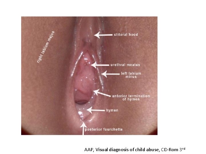 AAP, Visual diagnosis of child abuse, CD-Rom 3 rd 