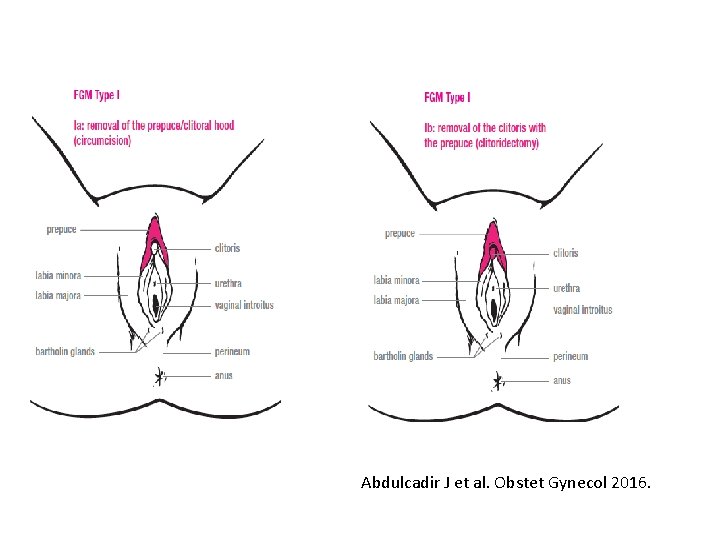Abdulcadir J et al. Obstet Gynecol 2016. 