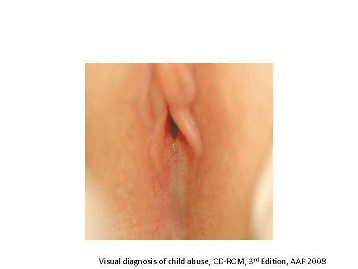 Visual diagnosis of child abuse, CD-ROM, 3 rd Edition, AAP 2008 