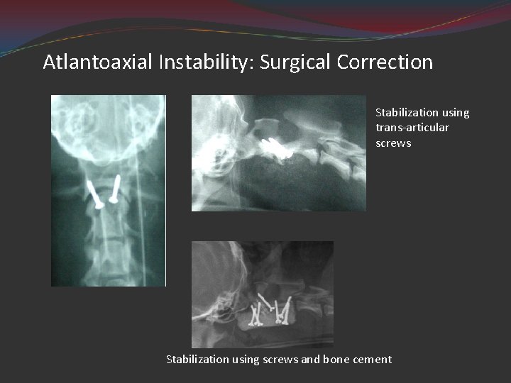 Atlantoaxial Instability: Surgical Correction Stabilization using trans-articular screws Stabilization using screws and bone cement