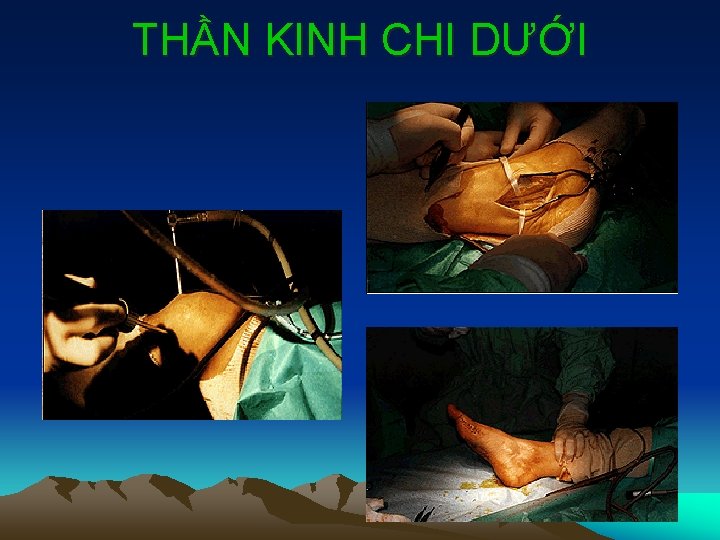 THẦN KINH CHI DƯỚI 